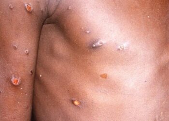 África declara la emergencia de salud pública continental por el brote de la viruela del mono