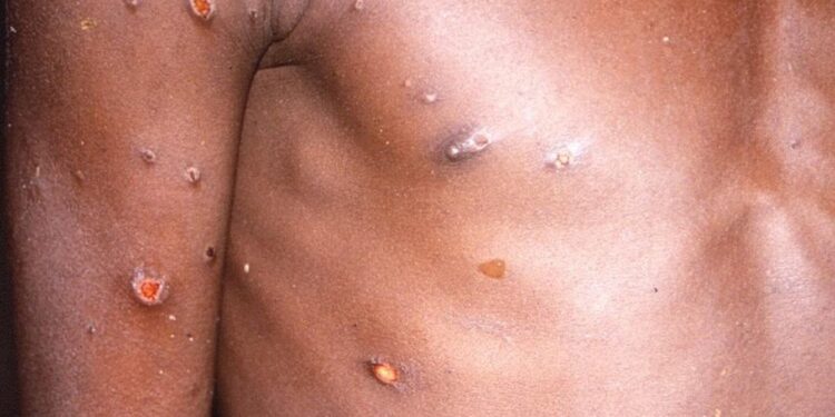 África declara la emergencia de salud pública continental por el brote de la viruela del mono