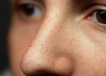 ¿Estamos a tiempo de evitar esas manchas en la piel que nos pueden amargar el verano?