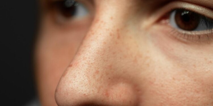¿Estamos a tiempo de evitar esas manchas en la piel que nos pueden amargar el verano?