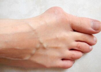 ¿Por qué se deforman los pies? ¿qué son, cómo se curan y por qué me salen juanetes?