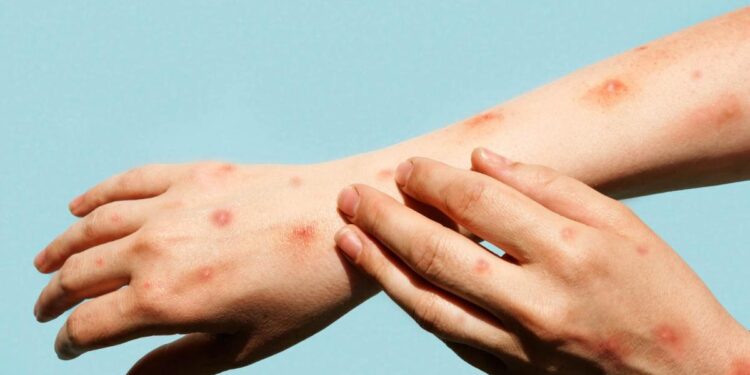 Los dermatólogos, sobre la nueva alerta por la propagación de la viruela del mono: ‘Hay que estar atentos’