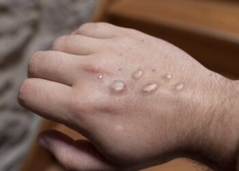 El aluvión de peticiones hace caer el sistema de citas para vacunarse del mpox en Madrid