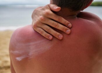 Quemaduras solares: remedios caseros para aliviar el dolor y cómo proteger la piel