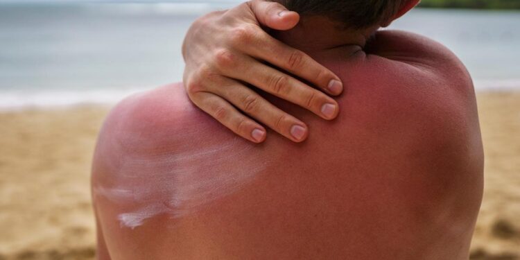 Quemaduras solares: remedios caseros para aliviar el dolor y cómo proteger la piel