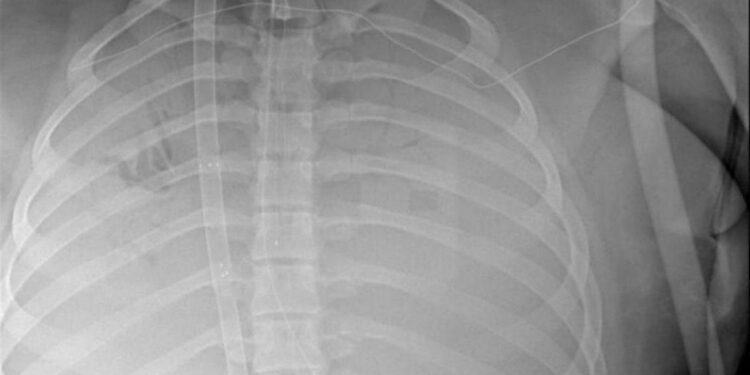 El caso de la niña que estuvo en estado crítico en Canadá demuestra que la gripe aviar puede ser muy grave