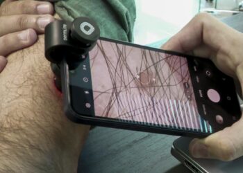 Cómo prevenir el melanoma, el cáncer de piel ‘peligroso y evitable’ que provoca 1.000 muertes al año en España