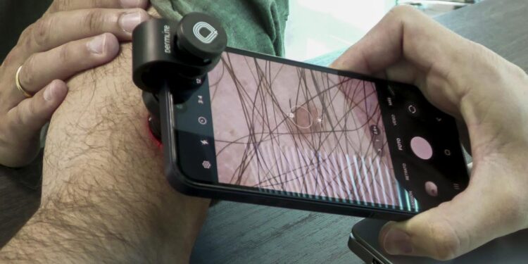 Cómo prevenir el melanoma, el cáncer de piel ‘peligroso y evitable’ que provoca 1.000 muertes al año en España