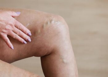 Adiós a las varices: así es el novedoso tratamiento indoloro para eliminarlas en tiempo récord