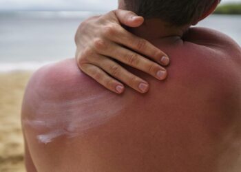 Cómo saber si tengo alergia al sol y consejos para prevenir su aparición