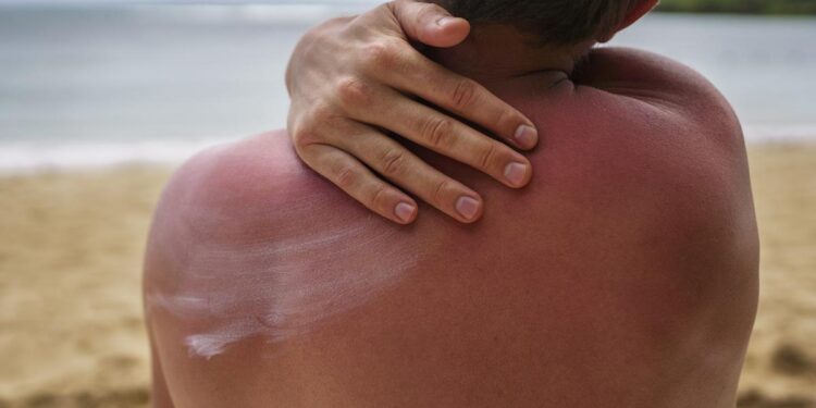 Cómo saber si tengo alergia al sol y consejos para prevenir su aparición