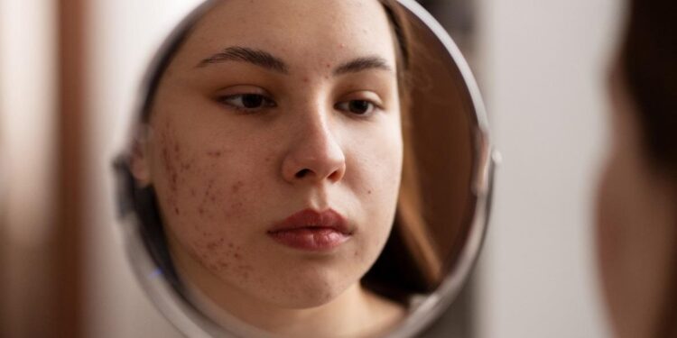Cómo cuidar tu piel si tienes acné en verano: protector solar, hidratación y productos que sí funcionan