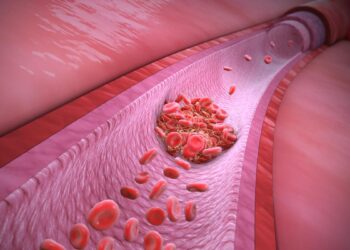 Trombosis: conoce cómo prevenir la enfermedad que mata una persona cada seis minutos