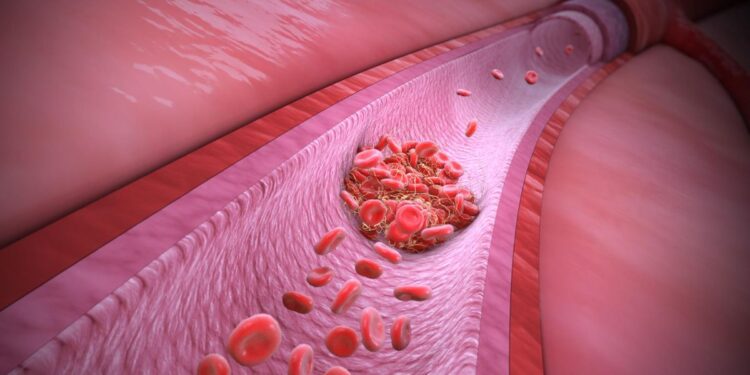 Trombosis: conoce cómo prevenir la enfermedad que mata una persona cada seis minutos