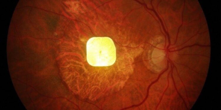 Un revolucionario chip logra restaurar la visión humana