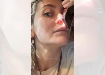 Los otorrinos advierten: las perforaciones nasales por cocaína son cada vez más grandes y destructivas